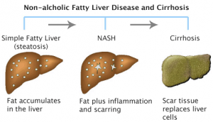 The progression of Non-Alcoholic Liver Disease